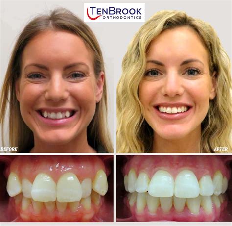 Transform Your Smile with the Power of Magical Orthodontic Appliances